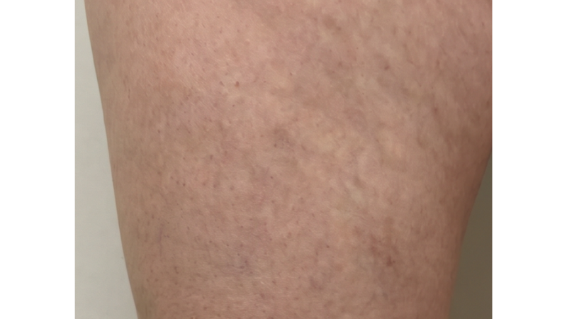 After vein treatment