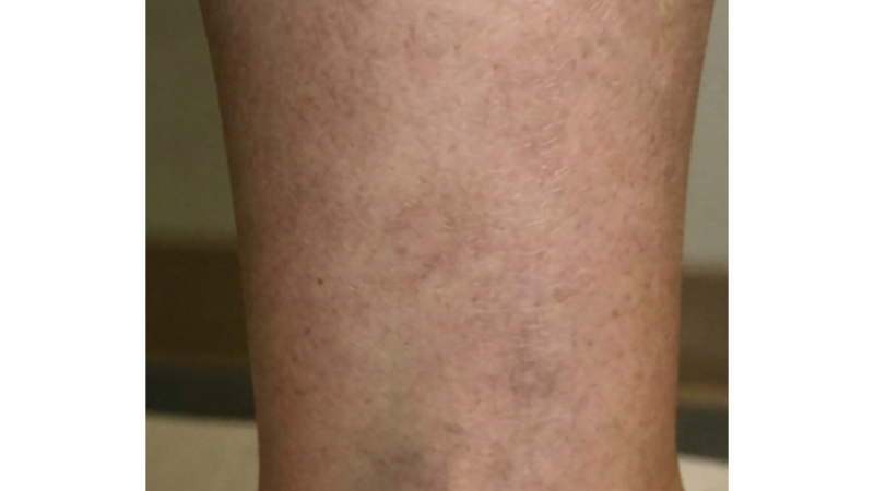 After vein treatment