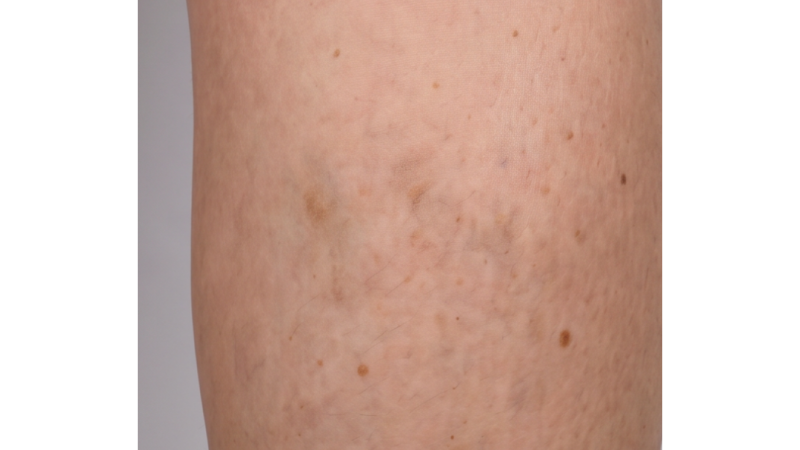 After vein treatment