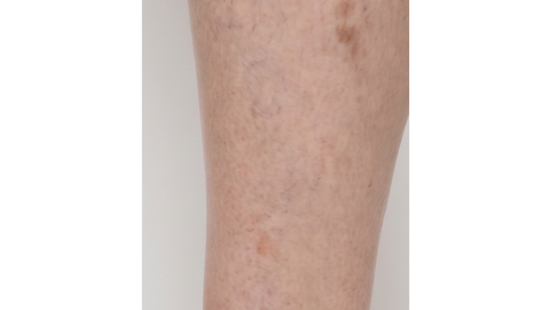 After vein treatment