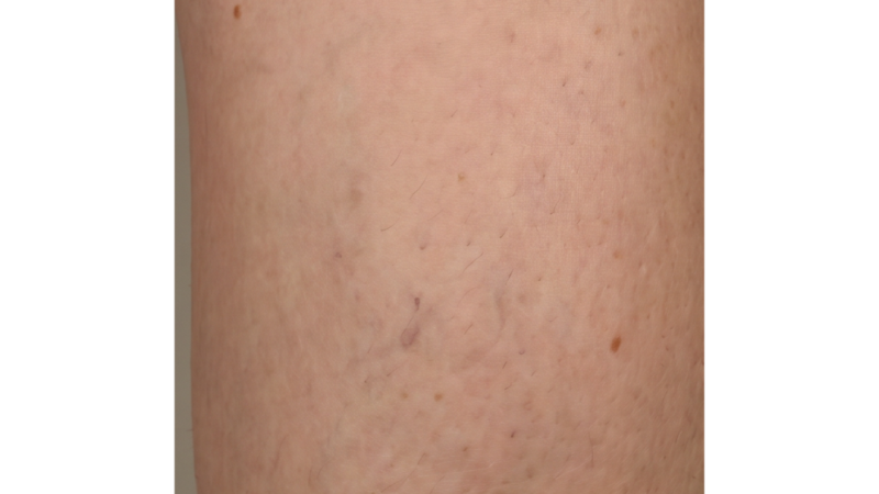 After vein treatment