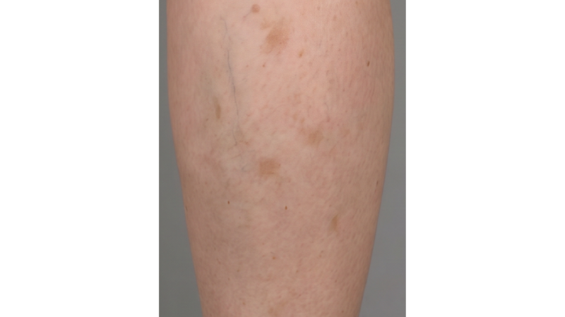 After vein treatment