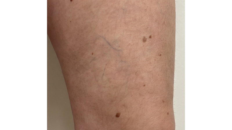After vein treatment