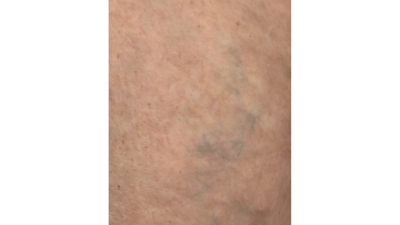 After vein treatment