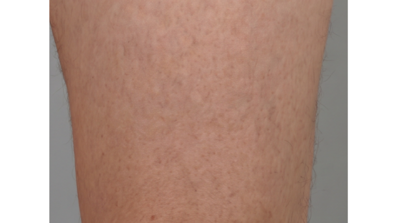 After vein treatment