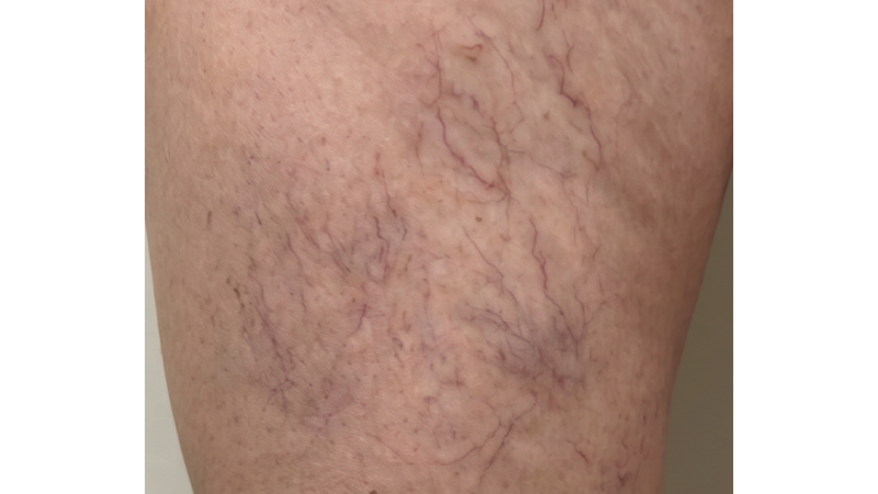 Before vein treatment