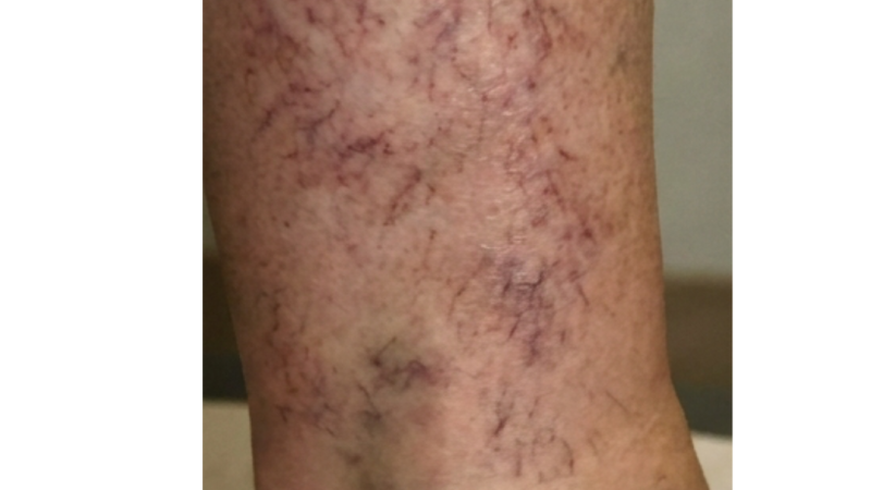 Before vein treatment