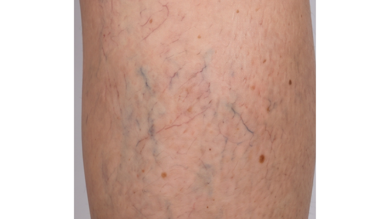 Before vein treatment
