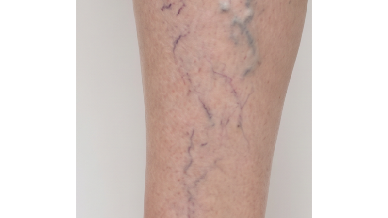 Before vein treatment