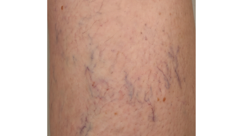 Before vein treatment