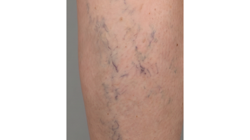 Before vein treatment