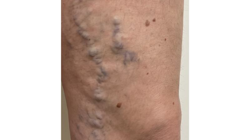 Before vein treatment