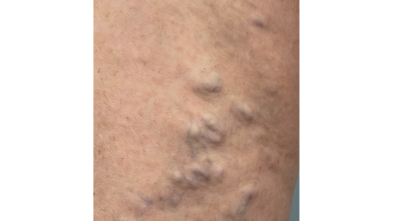 Before vein treatment