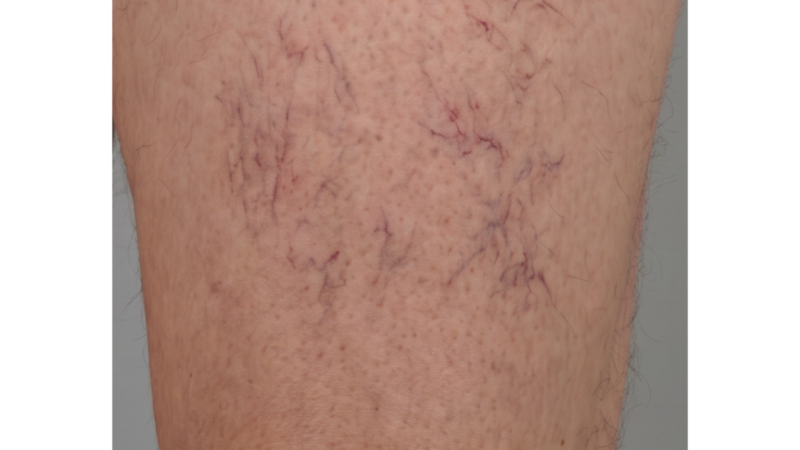 Before vein treatment